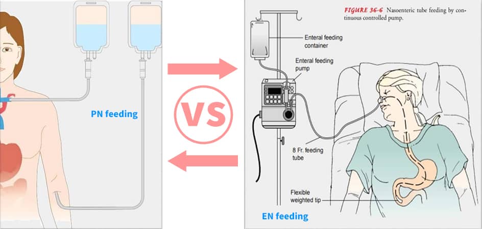 enteral feeding vs parenteral feeding